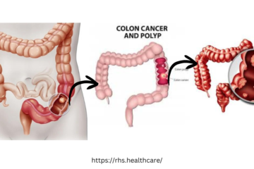 Symptoms of Colon Cancer