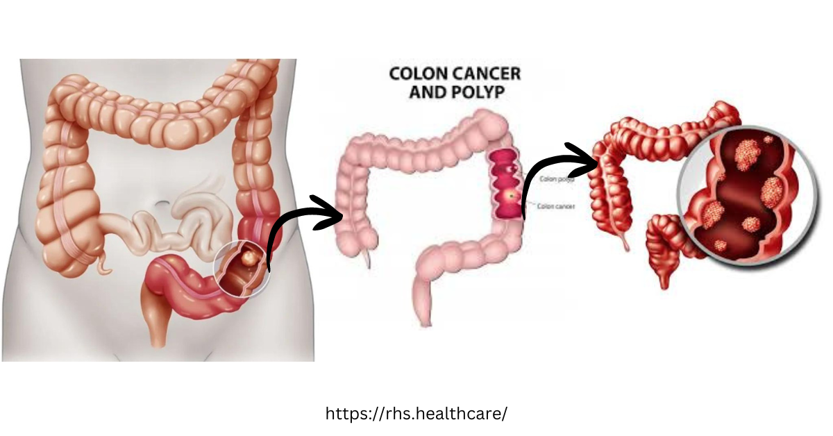 Symptoms of Colon Cancer